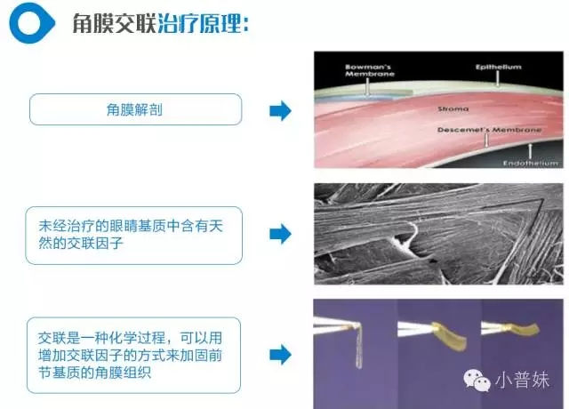 【直播】周繼容主刀角膜交聯(lián)術