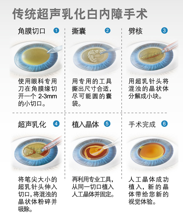 飛秒白內障和傳統(tǒng)白內障手術的區(qū)別